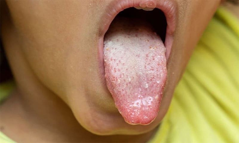 تلخی دهان و برفک دهان چه ارتباطی با هم دارند؟