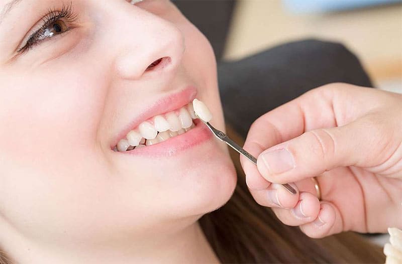 جای گذاری لمینت روی دندان چگونه انجام می شود؟