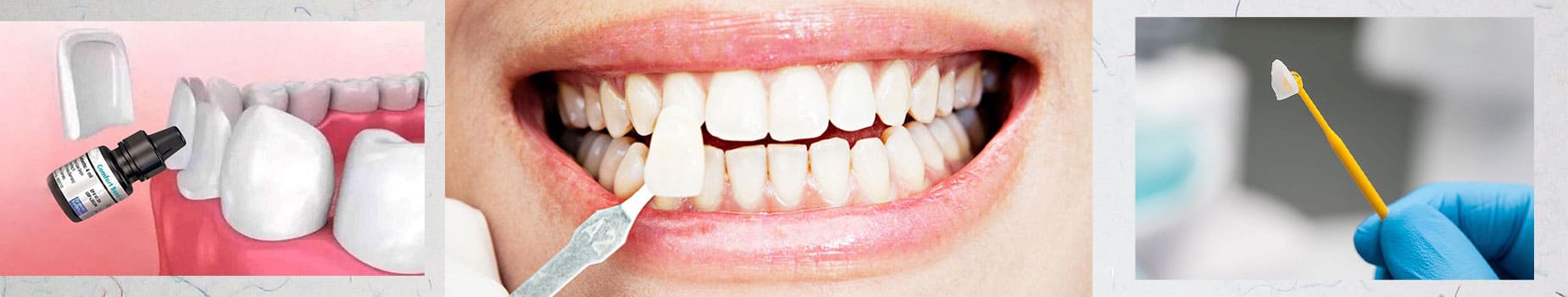 چسب روکش دندان چیست و چقدر دوام دارد؟