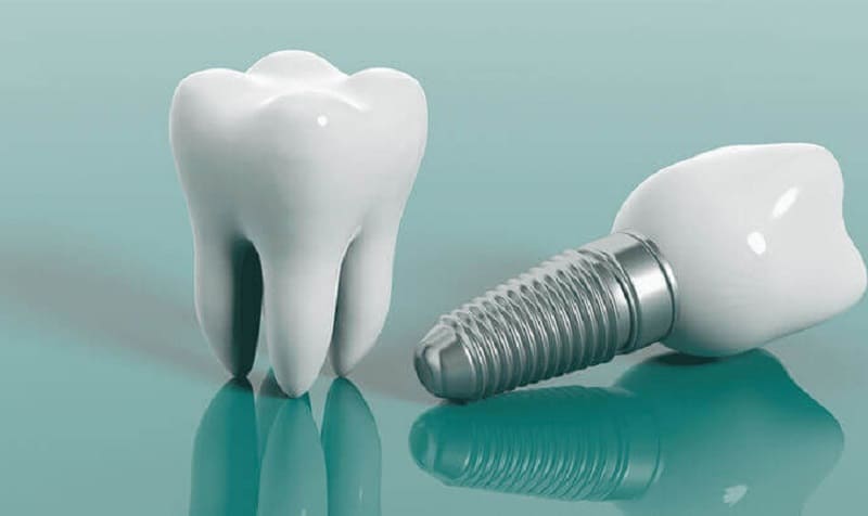 عوامل تاثیرگذار بر قیمت دندان دندان کدامند؟