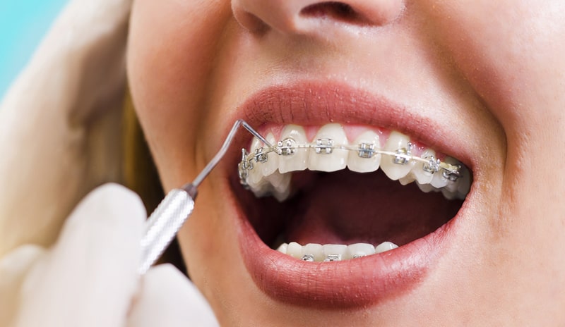 اقدامات قبل و بعد از ارتودنسی دندان