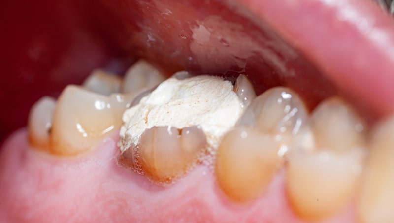 روکش موقت عصب کشی دندان
