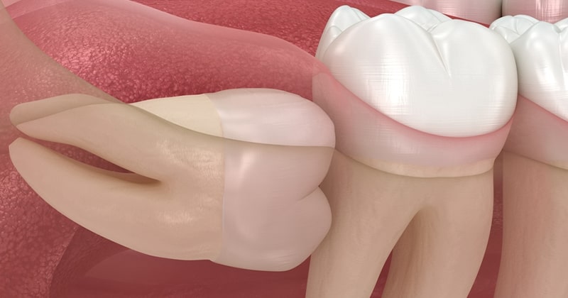 مشکلات ناشی از جراحی دندان عقل نهفته