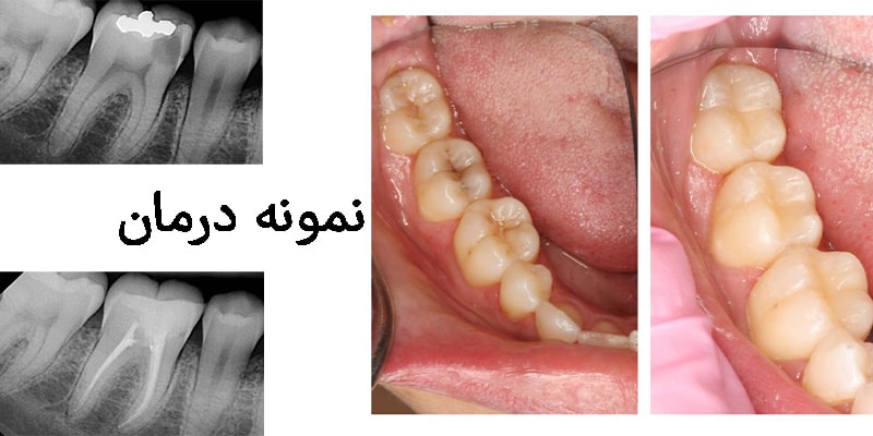 نمونه درمان متخصص ریشه دندان
