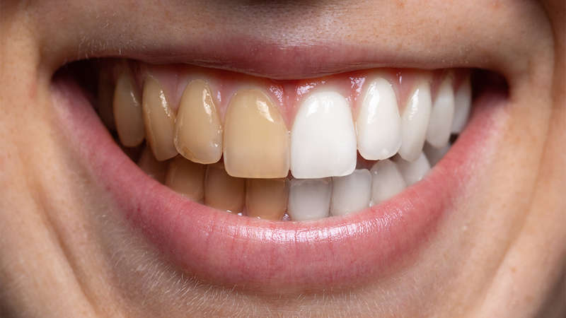 مزایای بلیچینگ نسبت به لمینت دندان