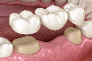 بریج دندان یا پل دندانی