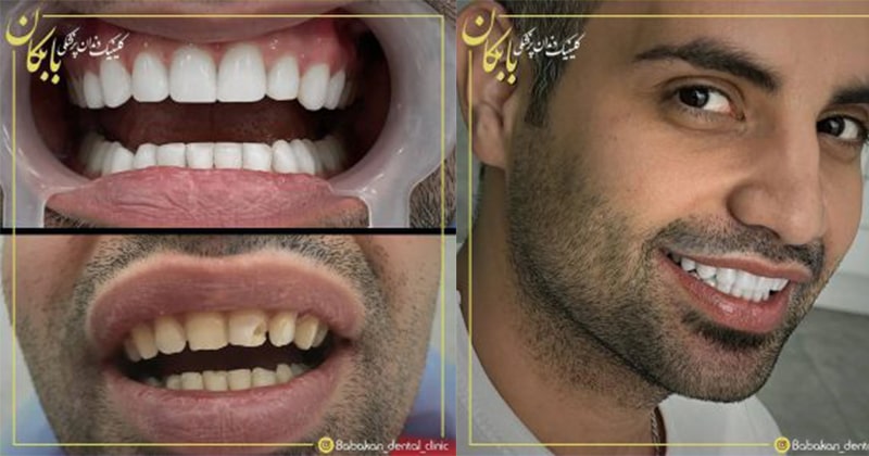 فرایند کامپوزیت دندان ها چگونه است؟