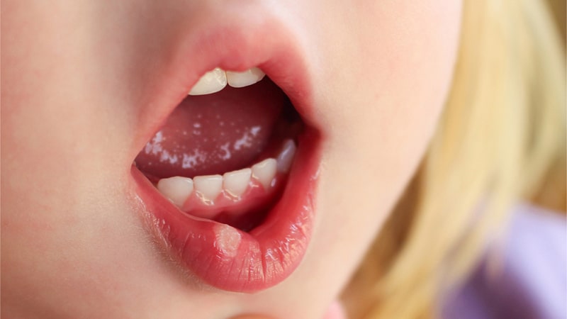 علت زخم دهان کودک
