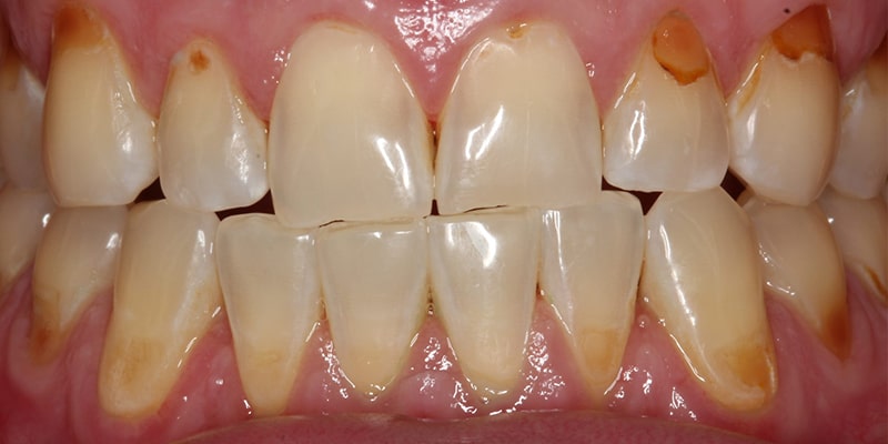 راه های جلوگیری از تاثیر رفلاکس معده بر دندان ها