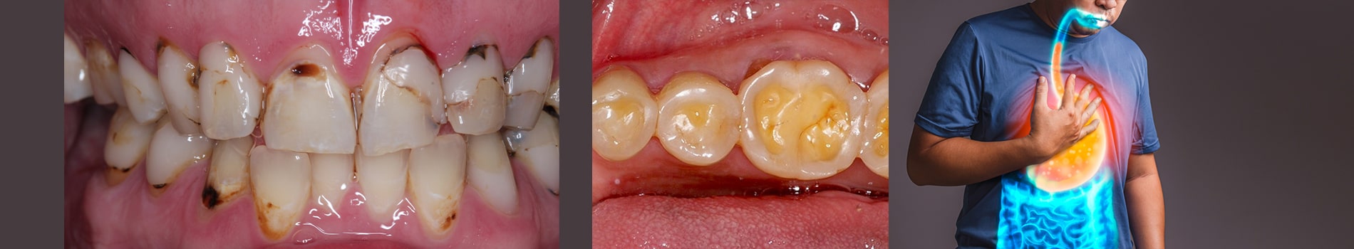 تاثیر اسید معده بر دندان