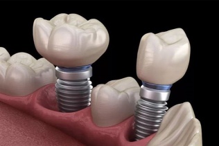راه های جایگزینی دندان چیست؟