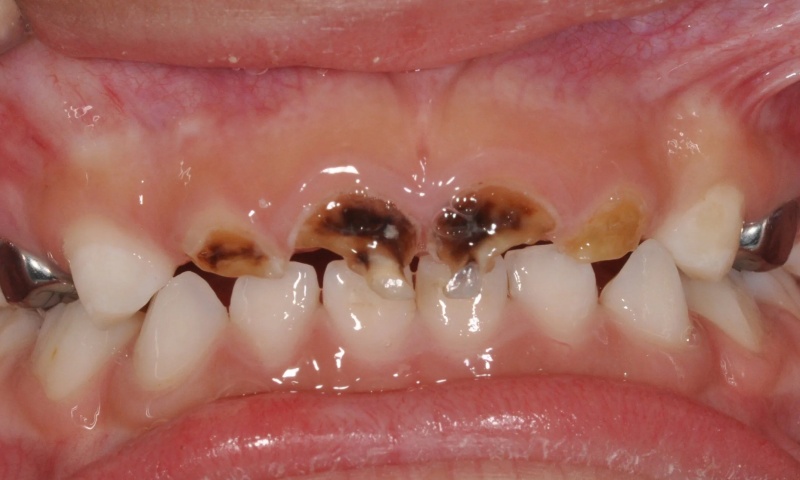 راه های شناسایی و پیشگیری از پوسیدگی دندان