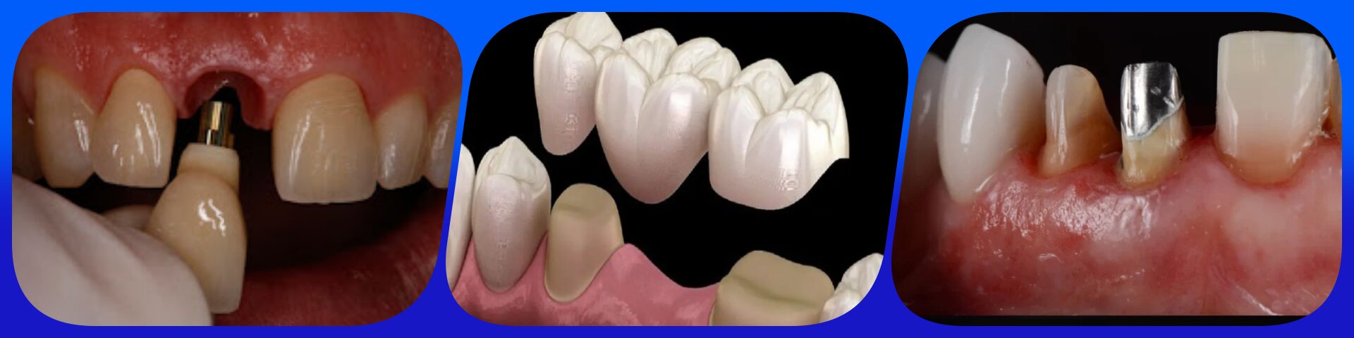 بریج دندان یا پل دندانی