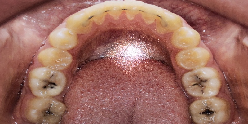 عوارض بریج دندانی