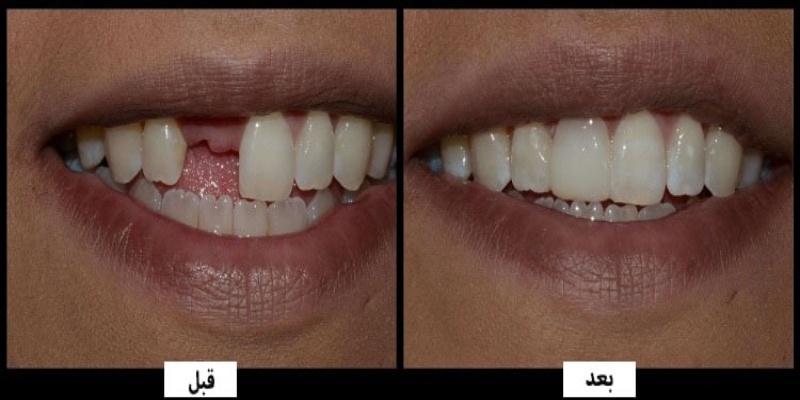 علت استفاده از پل دندانی