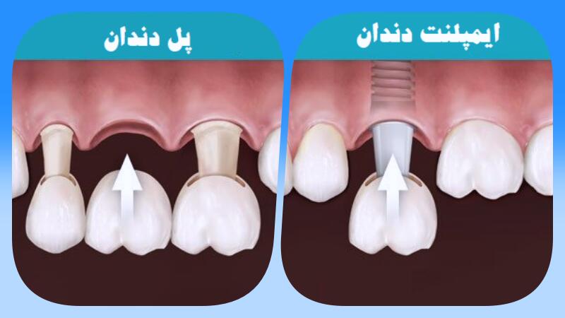 مقایسه مراحل ایمپلنت و بریج دندان