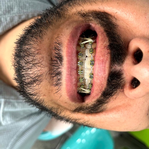 حین از انجام ارتودنسی دندان