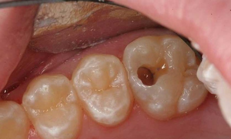 پوسیدگی دندان با وجود مسواک زدن