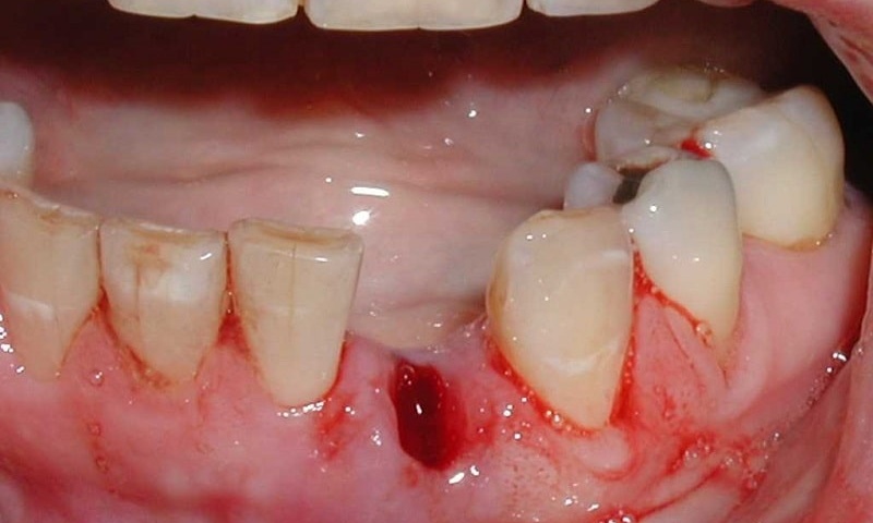علت درد بعد از کشیدن دندان