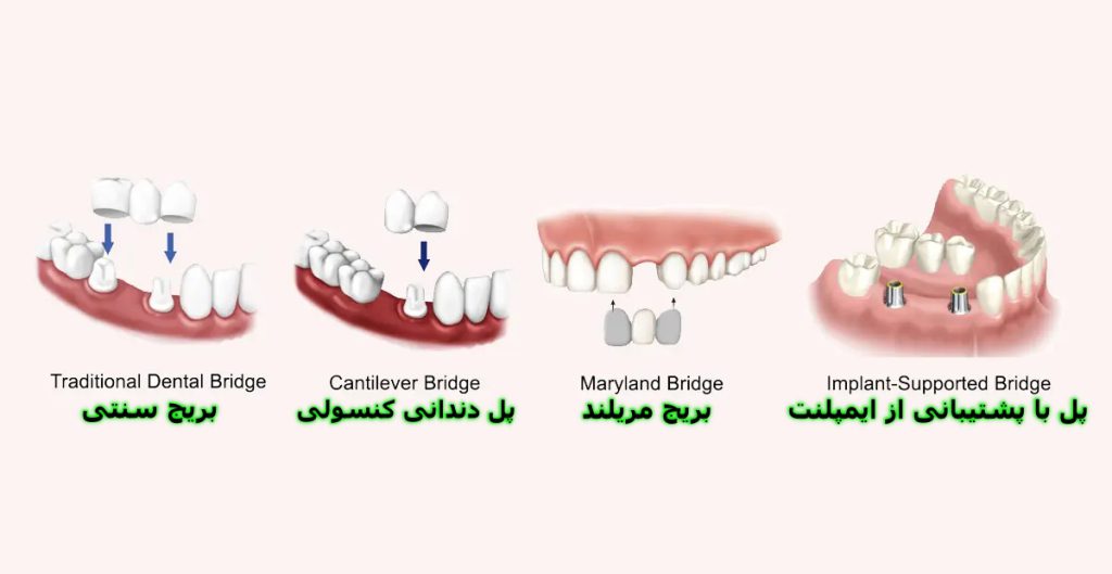انواع بریج دندانی کدامند؟