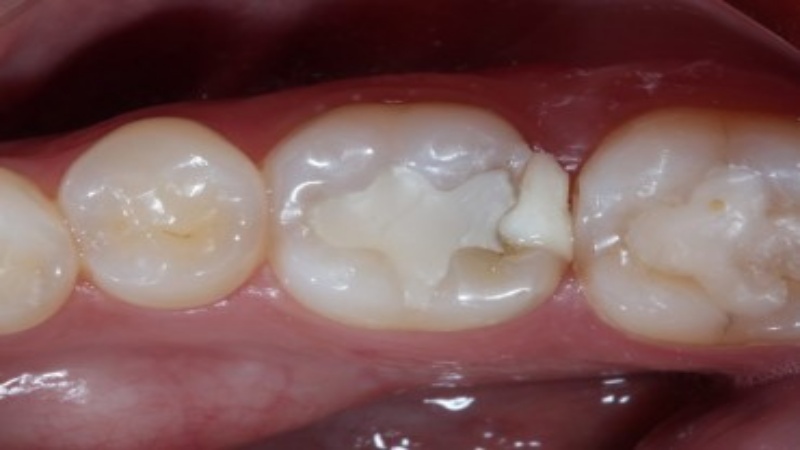 علت درد دندان پانسمان شده