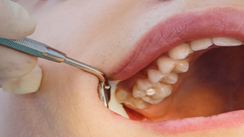 اگر پانسمان دندان عصب کشی شده افتاد چه کنیم؟
