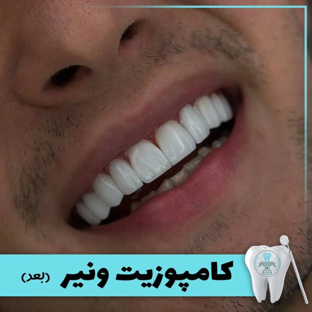نمونه درمان کامپوزیت دندان بابکان