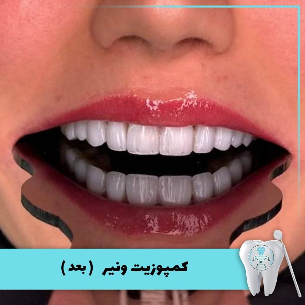 نمونه درمان کامپوزیت دندان بابکان