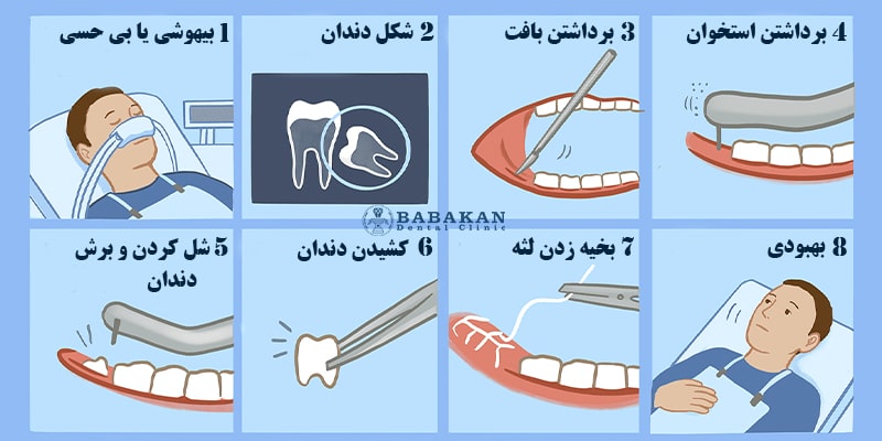 نحوه انجام جراحی دندان عقل نهفته