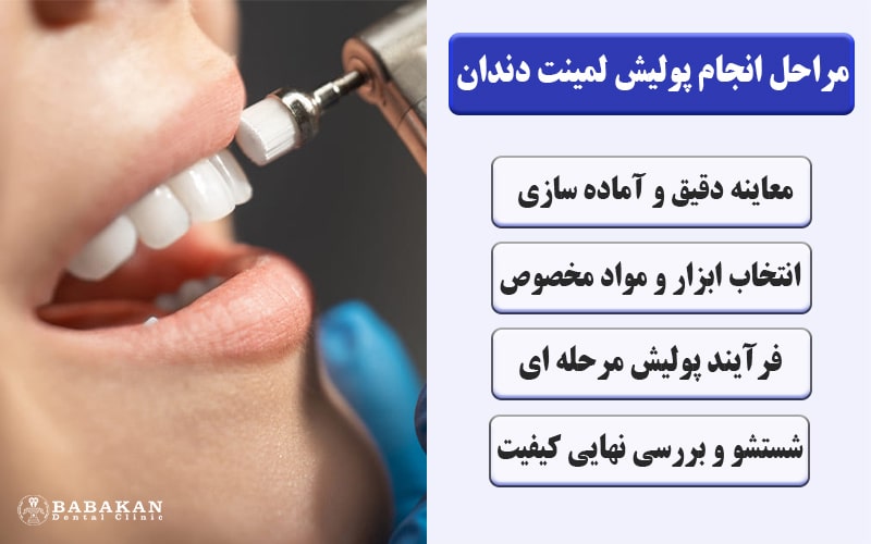 پولیش لمینت دندان
