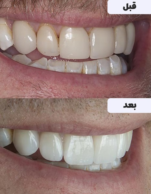 عکس قبل و بعد پولیش دندان
