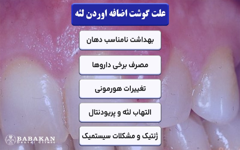 علت گوشت اضافه اوردن دهان
