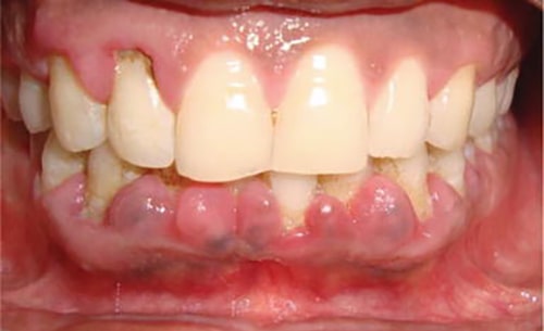 عکس گوشت اضافه در دهان