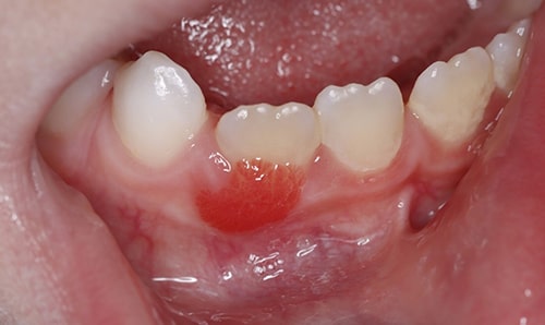 عکس گوشت اضافه در دهان