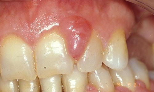 عکس گوشت اضافه در دهان