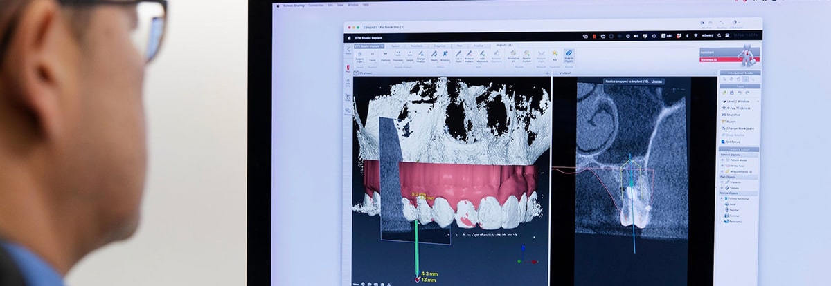 هزینه ایمپلنت دیجیتال دندان
