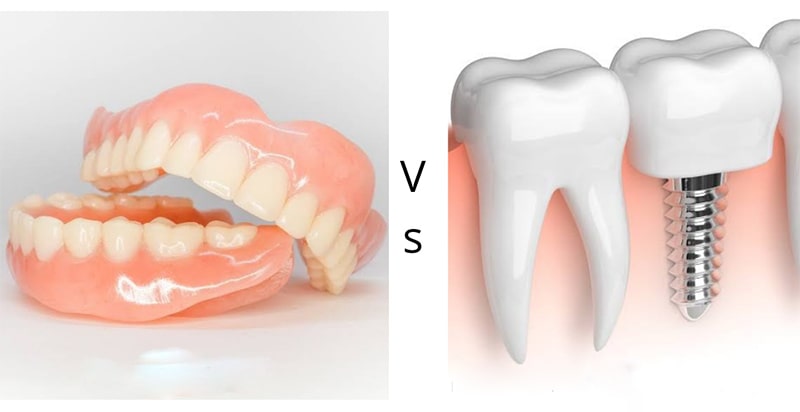 ایمپلنت بهتر است یا دندان چسبی