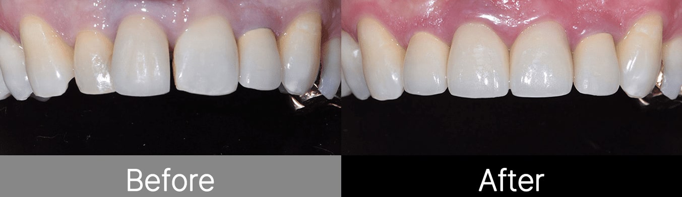 هزینه انواع برند ایمپلنت کره ای