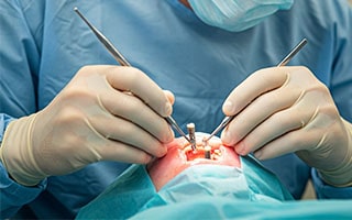 بهترین متخصص ایمپلنت