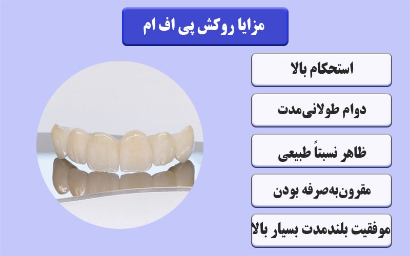 مزایا روکش پی اف ام
