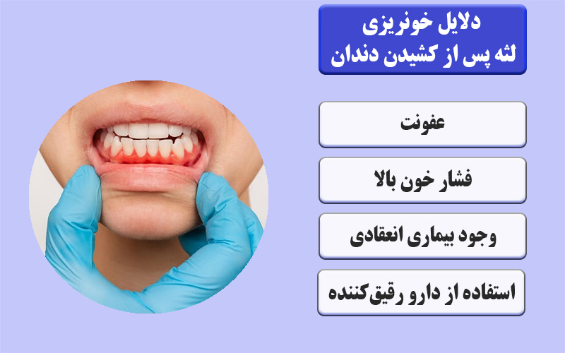 دلایل شایع خونریزی لثه پس از کشیدن دندان