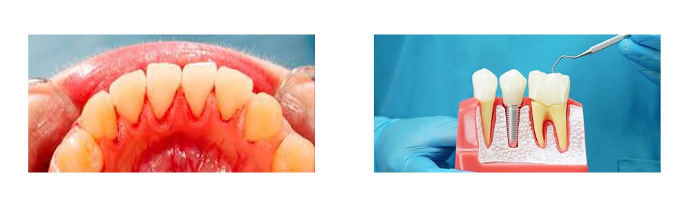 جراحی لثه برای ایمپلنت