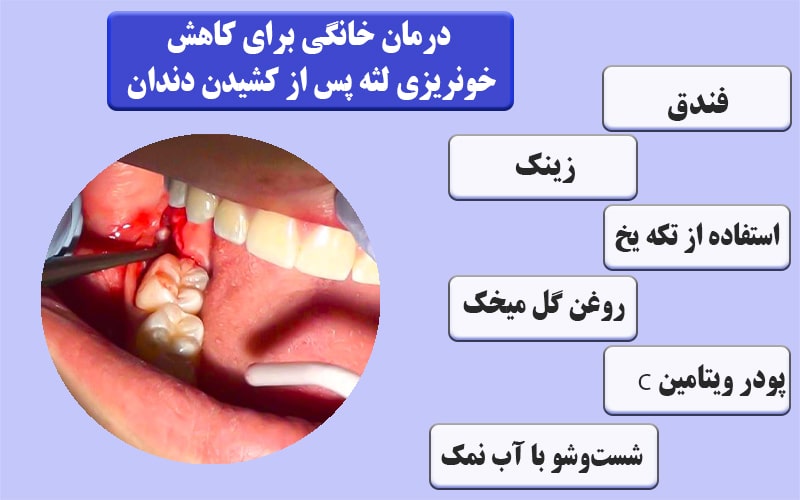 درمانهای خانگی برای کاهش خونریزی لثه پس از کشیدن دندان