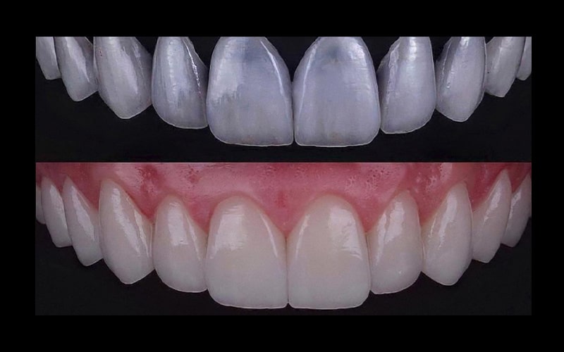 روش انجام کامپوزیت شیشهای دندان