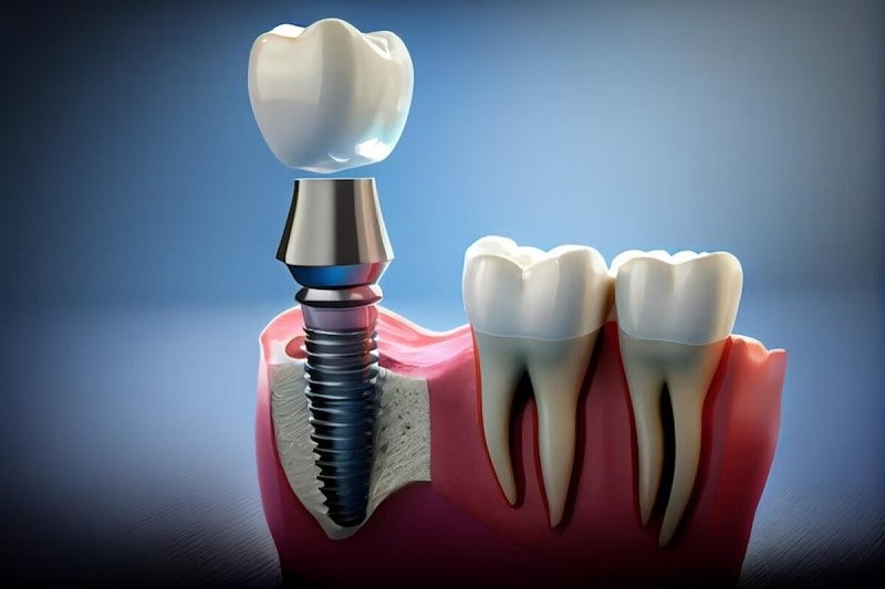 نحوه کاشت ایمپلنت مگاژن