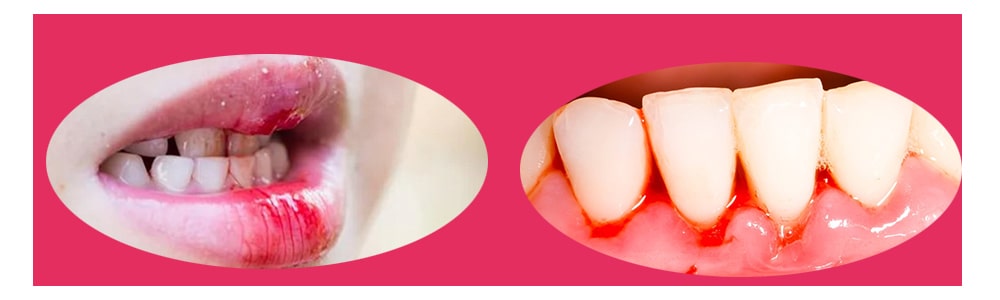 دلیل خونریزی لثه پس از کشیدن دندان