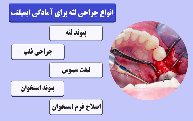 انواع جراحی لثه برای آمادگی ایمپلنت