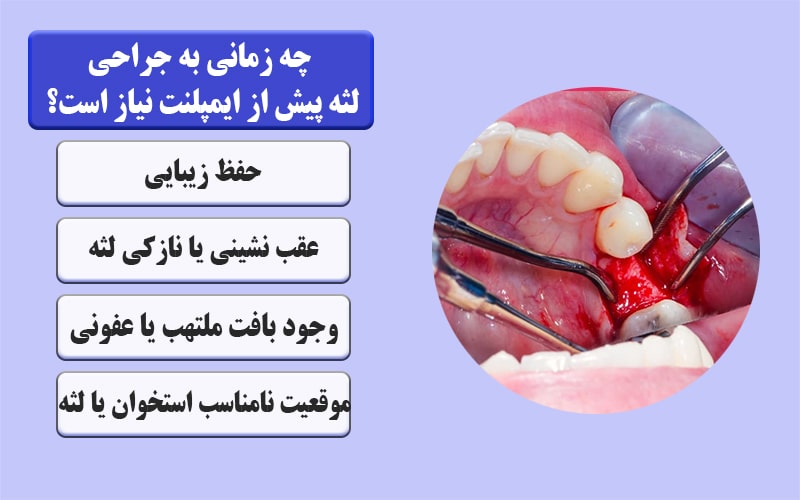 چه زمانی به جراحی لثه پیش از ایمپلنت نیاز است