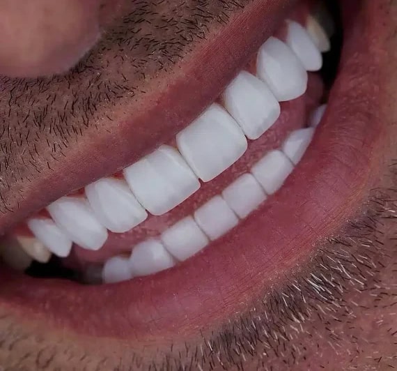 کامپوزیت دندان شیشه ای