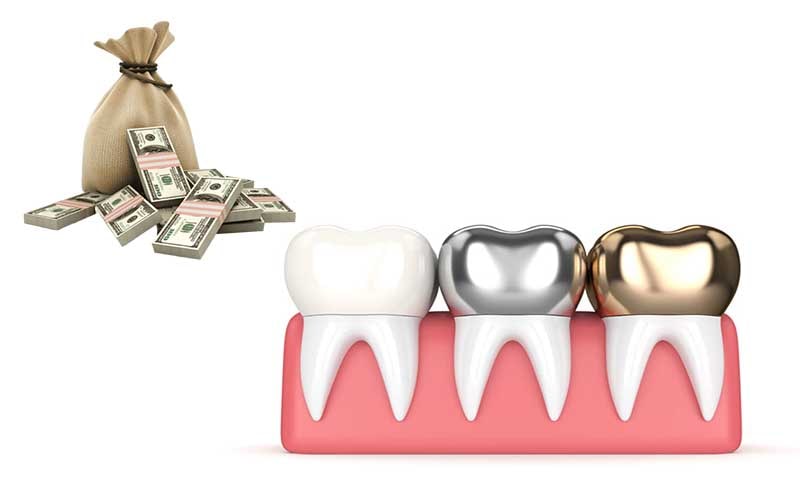 قیمت روکش دندان پی اف ام